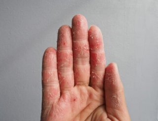 Disidrosi Sintomi E Cure Naturali Di Un Eczema Che Prende Piedi E Mani